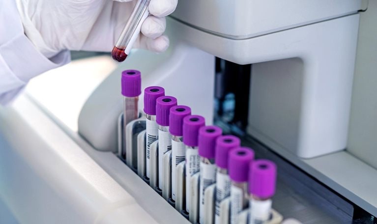 Close-up of a doctors hand looking at blood sample test tube in a machine