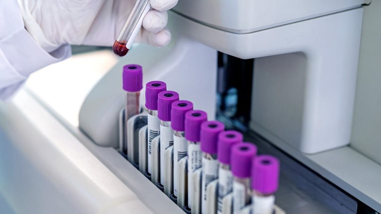 Close-up of a doctors hand looking at blood sample test tube in a machine
