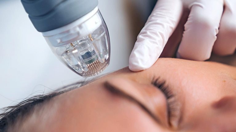An image of a person having a microneedle RF lifting procedure.